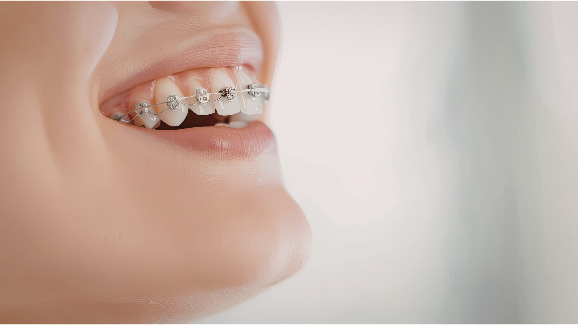 pyrenees-orthodontie-chirurgien-dentiste-appareil-dentaire-cabestany-66-bague-adulte-enfant-aligneur