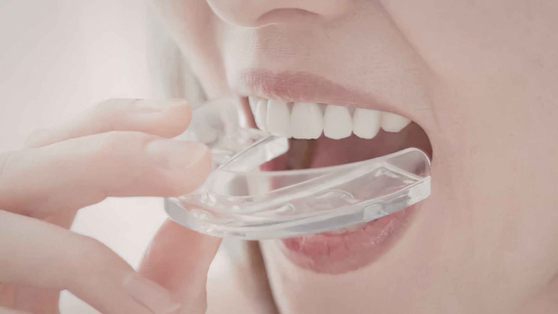 pyrenees-orthodontie-chirurgien-dentiste-appareil-dentaire-cabestany-66-bague-adulte-enfant-aligneur